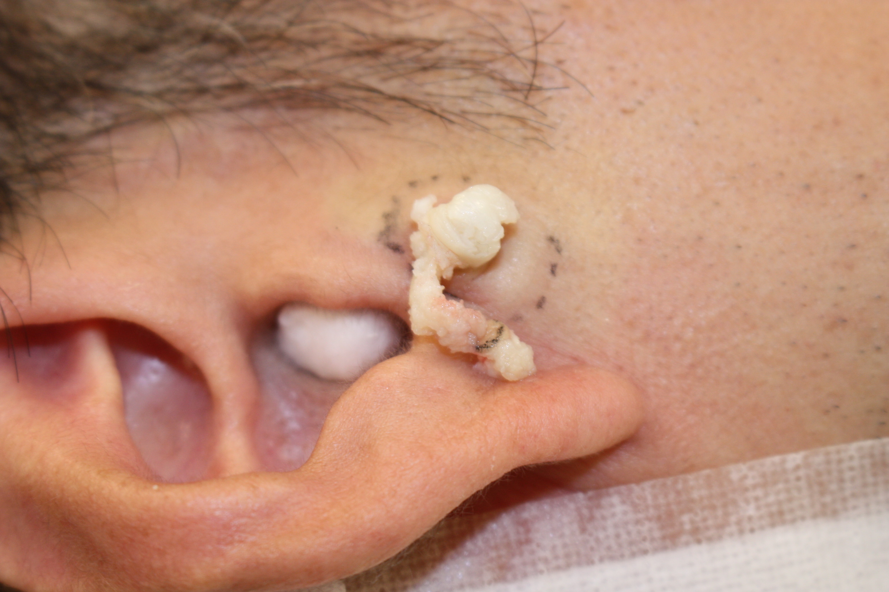 しこり 耳たぶ 耳たぶのしこり 症状の原因・病気一覧・診療科